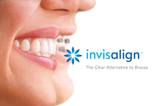 Invisalign Clear Aligners